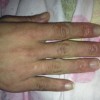 女性冬季穿长筒靴存在冻疮威胁