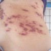 带状疱疹不治疗危害是什么