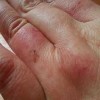 宝宝冻疮的防护与治疗