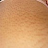 鱼鳞病给患者带来哪些危害
