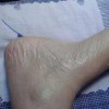 什么是鱼鳞病的致病因素呢