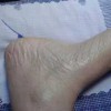 鱼鳞病皮肤干燥的原因是什么