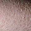 腿上长鱼鳞病是不是因为感染