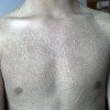 预防鱼鳞病该注意些什么