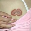 长增生症疤痕的原因