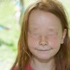 夏季要如何防治雀斑呢