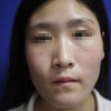 对于雀斑我们应该怎样的预防