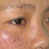 雀斑的有效预防办法有什么