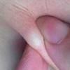多发性脂肪瘤可能的病因都有哪些呢
