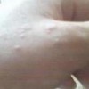 花斑癣治疗的措施是什么呢