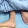 护理脓疱疮病人防脓疱扩散