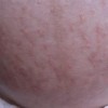 皮肤瘙痒对患者造成的影响
