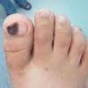晕痣的病理学特征分析