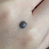 色素痣是如何形成的