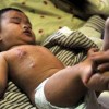 新生儿脓疱疮的发病特点