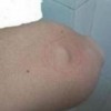 什么治疗的手法预防乳腺脂肪瘤