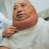 脂肪瘤的预防是否重要呢