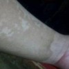 花斑癣的常见治疗的手法是什么