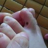 孩子身上有无色素痣