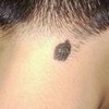了解黑痣的形成因素
