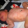 新生儿脓疱疮的致病因素