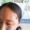 带状疱疹病毒怎么治疗  带状疱疹治疗的手法