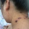 带状疱疹的治疗办法有什么