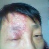 带状疱疹后遗症怎么治疗 带状疱疹神经痛治疗