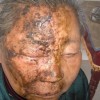 带状疱疹的治疗的手法 如何治疗带状孢疹
