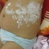 带状疱疹的治疗原则和诊断要点