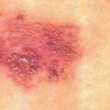 带状疱疹的感染是什么导致的