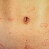 带状疱疹复发的有哪些因素呢