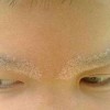 带状疱疹的预防措施是什么