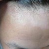 白斑初期病情