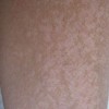 宝宝4个月大腿外侧怎么有块白斑