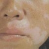 白斑和生育有关系吗