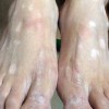 白斑患者的饮食需要禁忌哪些？ 白斑患者应该吃什么食品