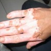 白斑患者需避免吃什么食物