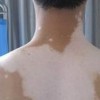 7岁小孩白斑期间能吃钙片和维C吗