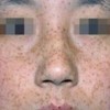黄褐斑疾病的预防措施