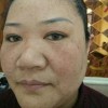 口服药治疗黄褐斑的办法有什么