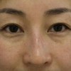 黄褐斑治疗后多久见效呢