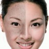 黄褐斑的治疗办法有什么