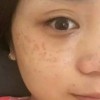 黄褐斑可以根治吗-揭秘黄褐斑的五大治疗的手法