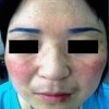 黄褐斑治疗的手法是什么