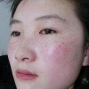 了解除掉面部黄褐斑的措施