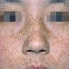 除掉黄褐斑最好的措施