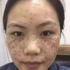 除掉面部黄褐斑