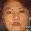黄褐斑治疗后多久见效