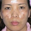 4招帮女人祛除黄褐斑 改善面色